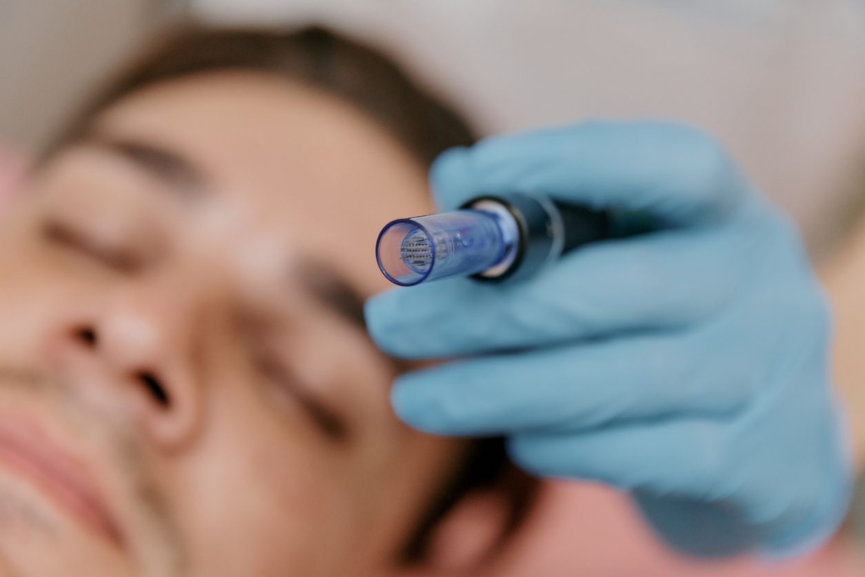 Gloved hand holding microneedling device near a man's face for skin treatment.