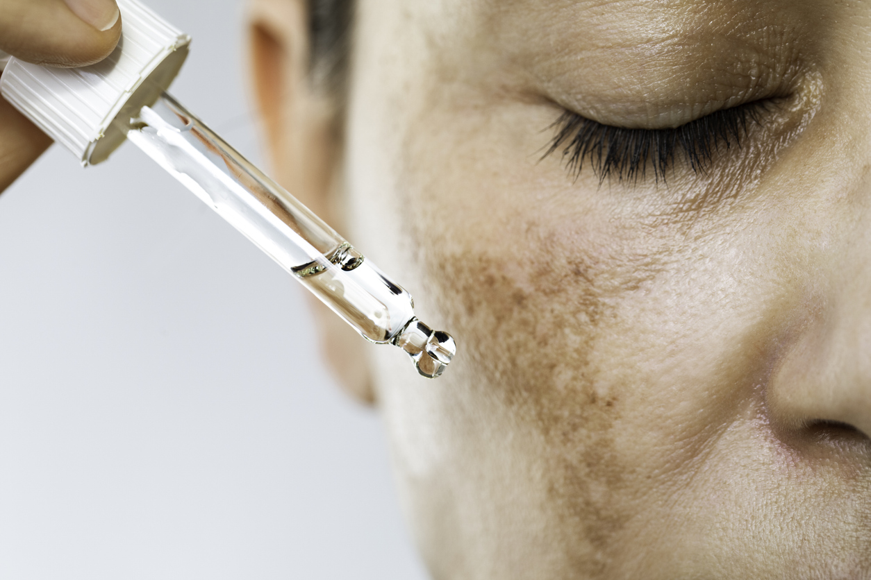 Close-up of a woman applying skin serum with a dropper to facial hyperpigmentation and dark spots.