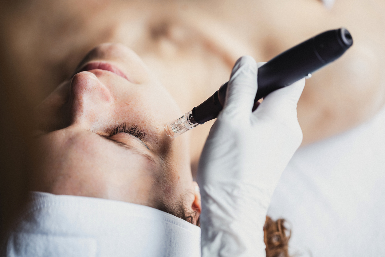 Close-up of a woman receiving microneedling facial with a dermapen device applied under the eye by gloved hand.