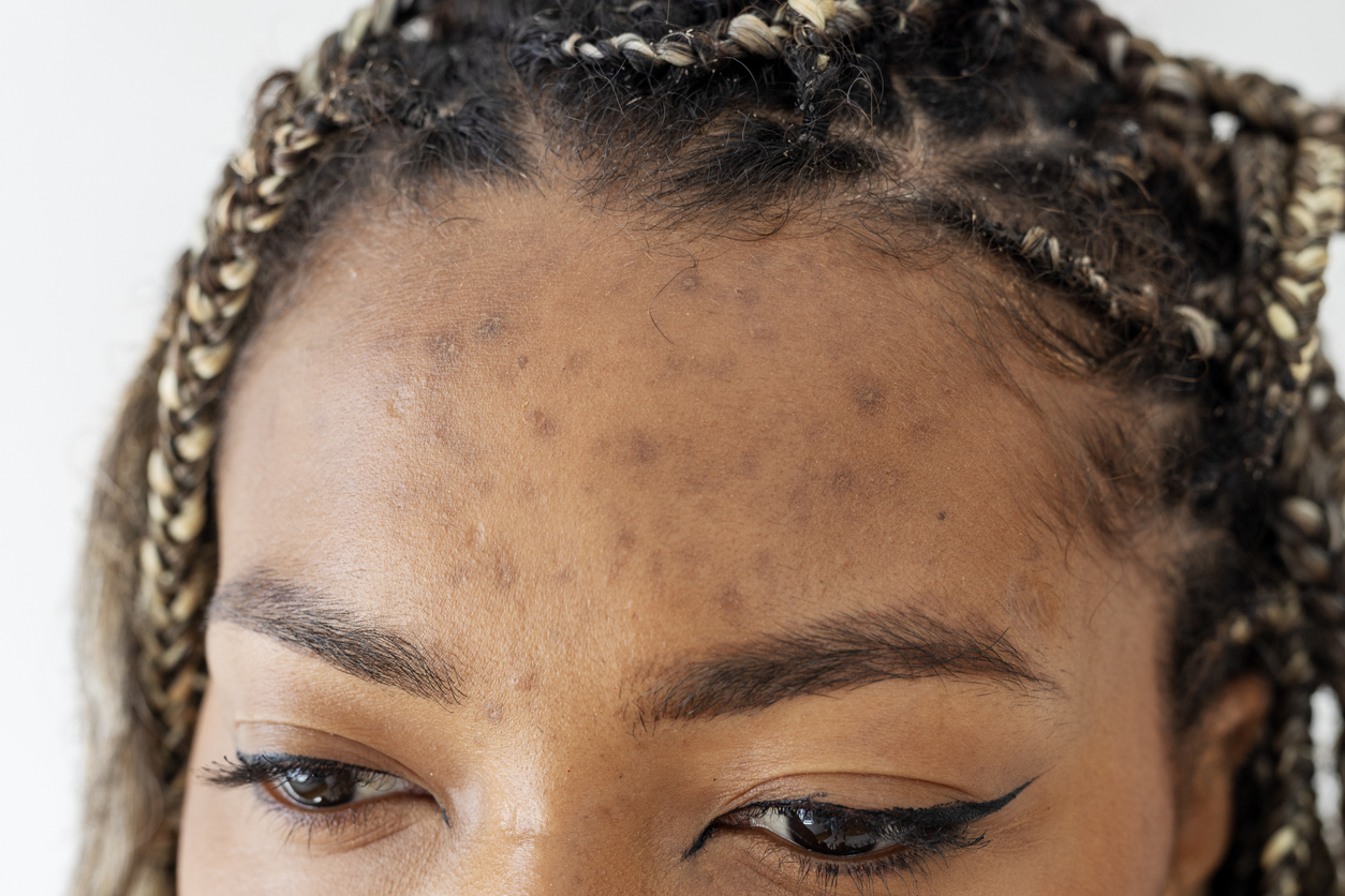Close-up of a woman's forehead with acne scars, braided hair and winged eyeliner