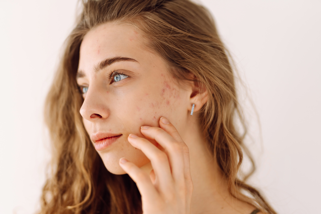 Close-up of young woman with acne touching cheek, looking sideways in soft natural light, skincare