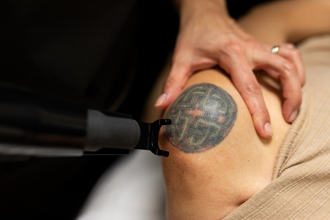 Laser device targeting a circular tattoo on a person's upper arm during tattoo removal treatment