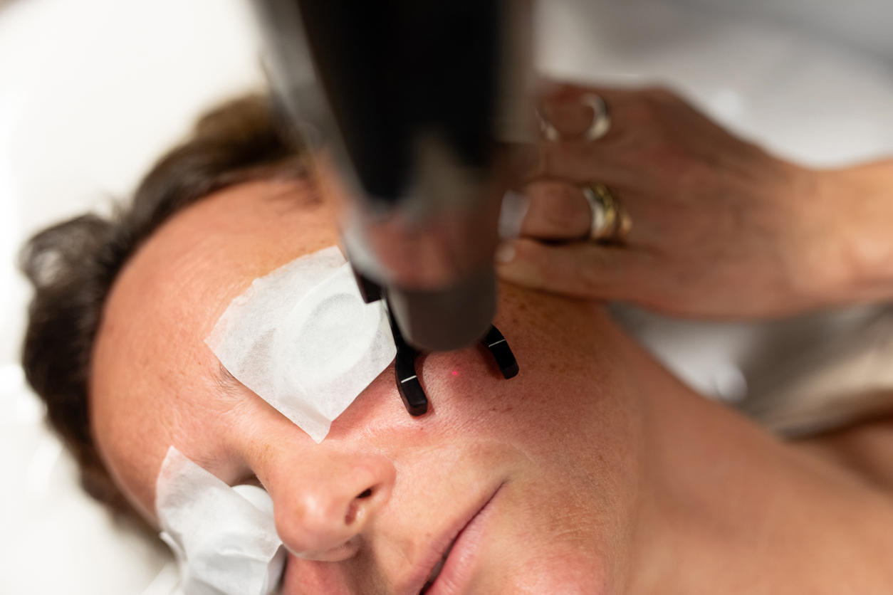 A woman receiving facial laser treatment on her cheek with eyes covered by protective pads